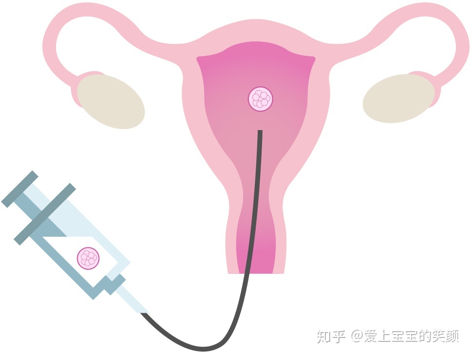温州首个供卵第三代试管助孕10岁了，至今已有4200个成功案例